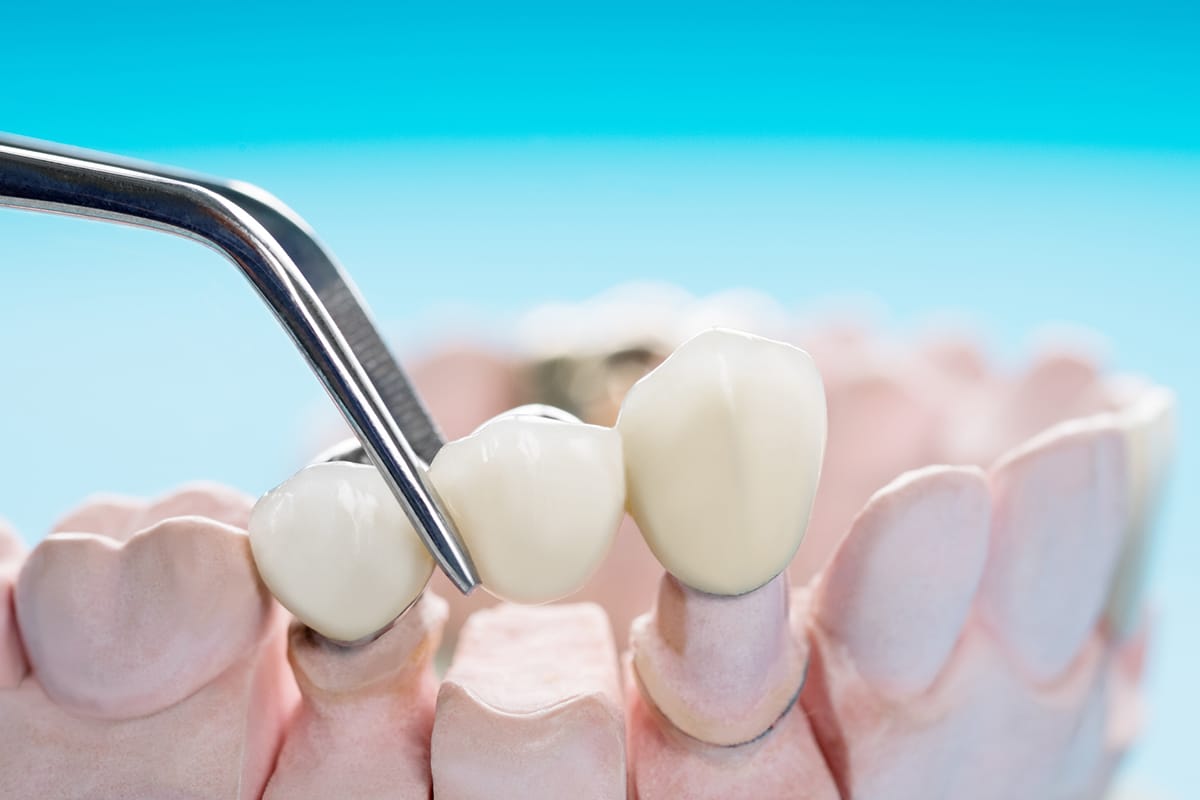 Can A Dental Bridge Be Removed And Recemented?