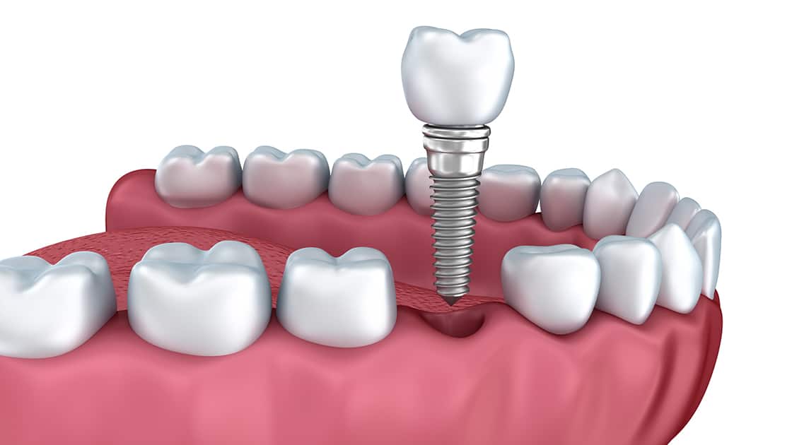 Illustration of Dental Implant photo