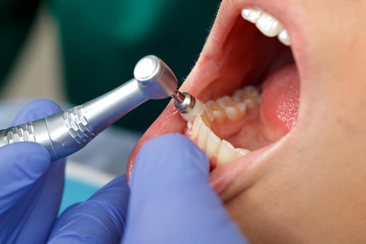 how-long-does-a-dental-deep-cleaning-take-oakland-dental-care