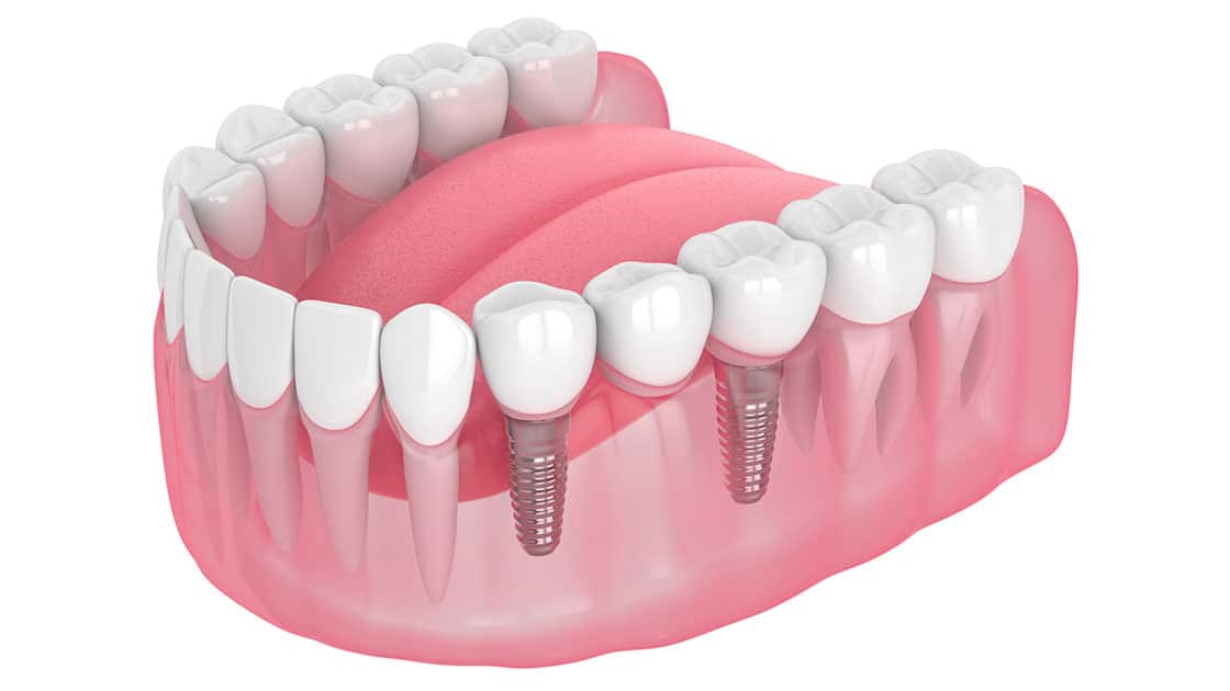 Dental Bridge Photo