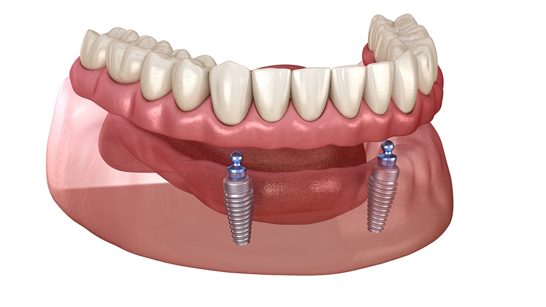 Implant Supported Dentures