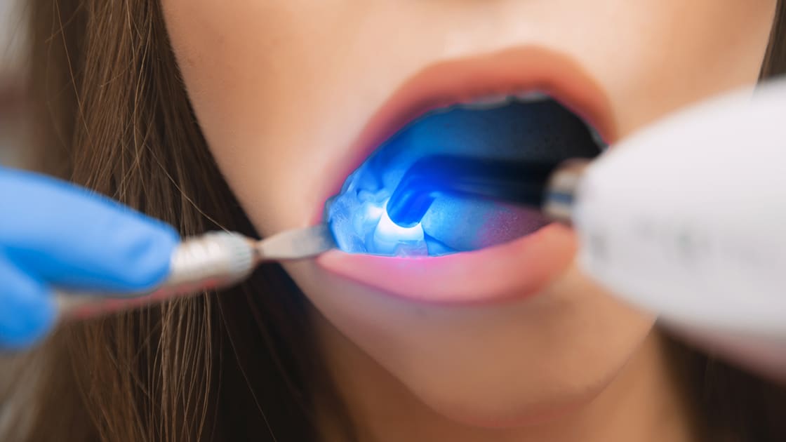 Dental laser