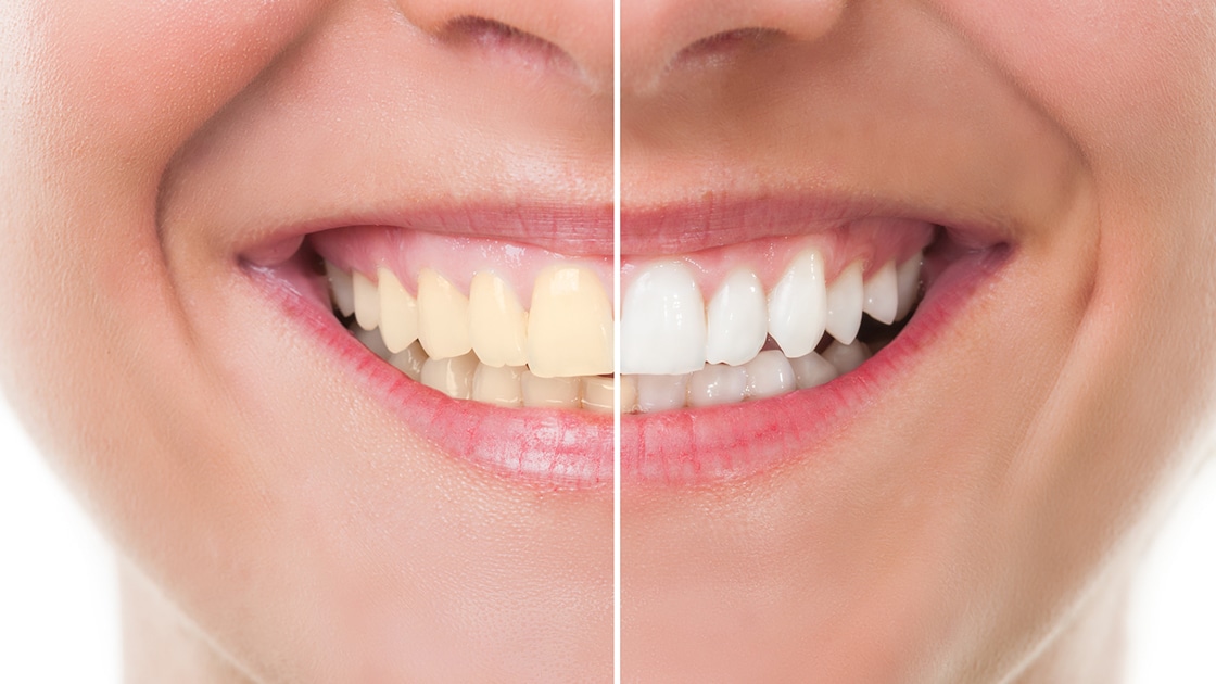 Before and After image of teeth whitening