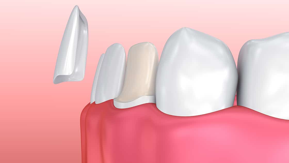 Illustration of Dental Veneers